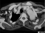 Cervical Aortic Arch